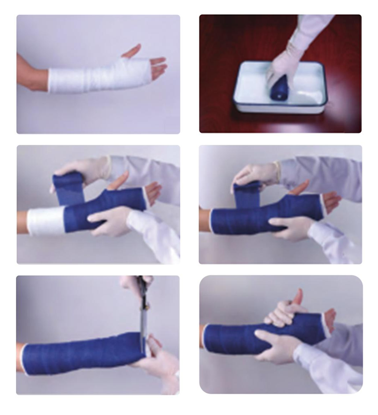 Stappen voor het gebruik van de orthopedische giettape